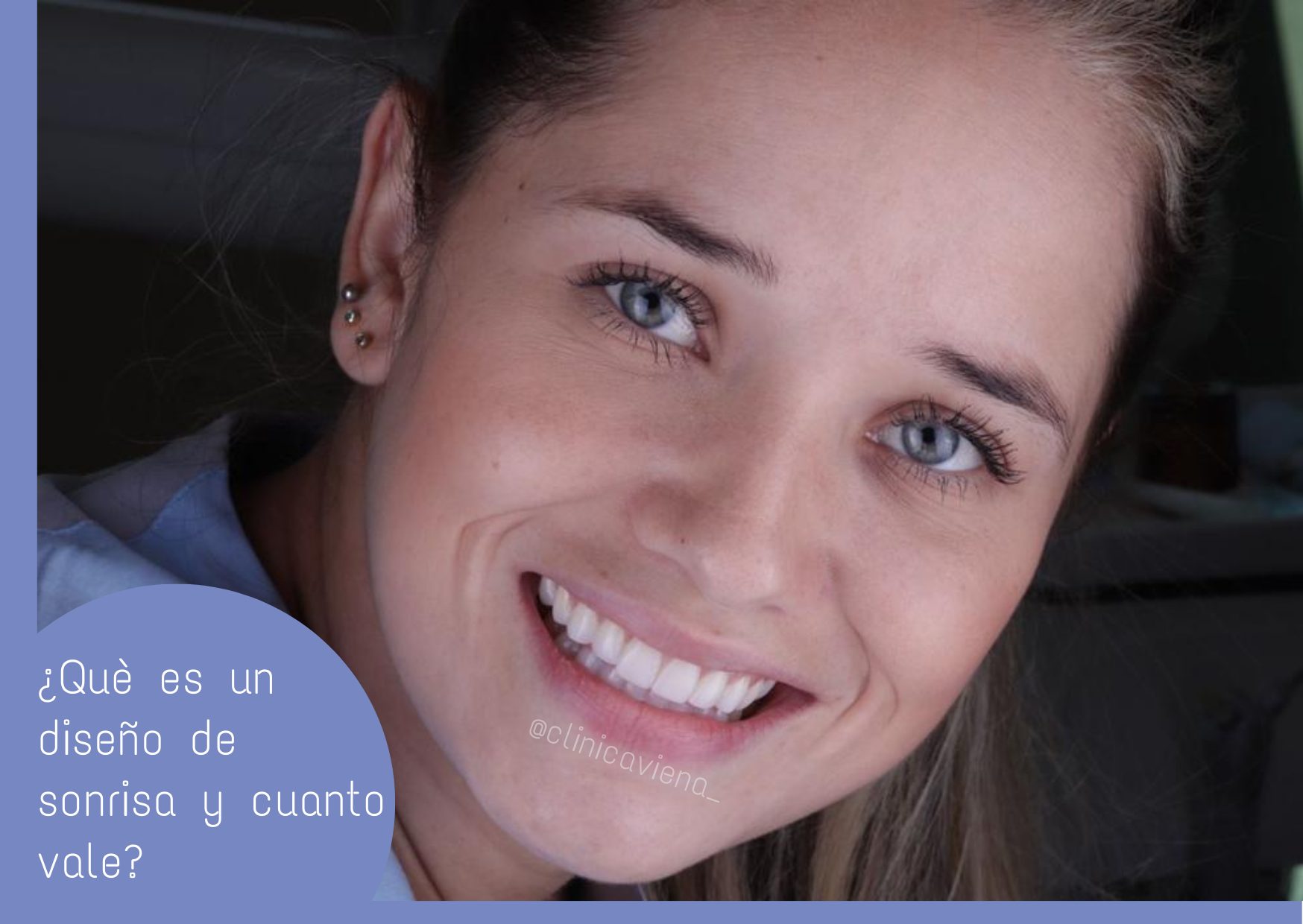 diseño de sonrisa