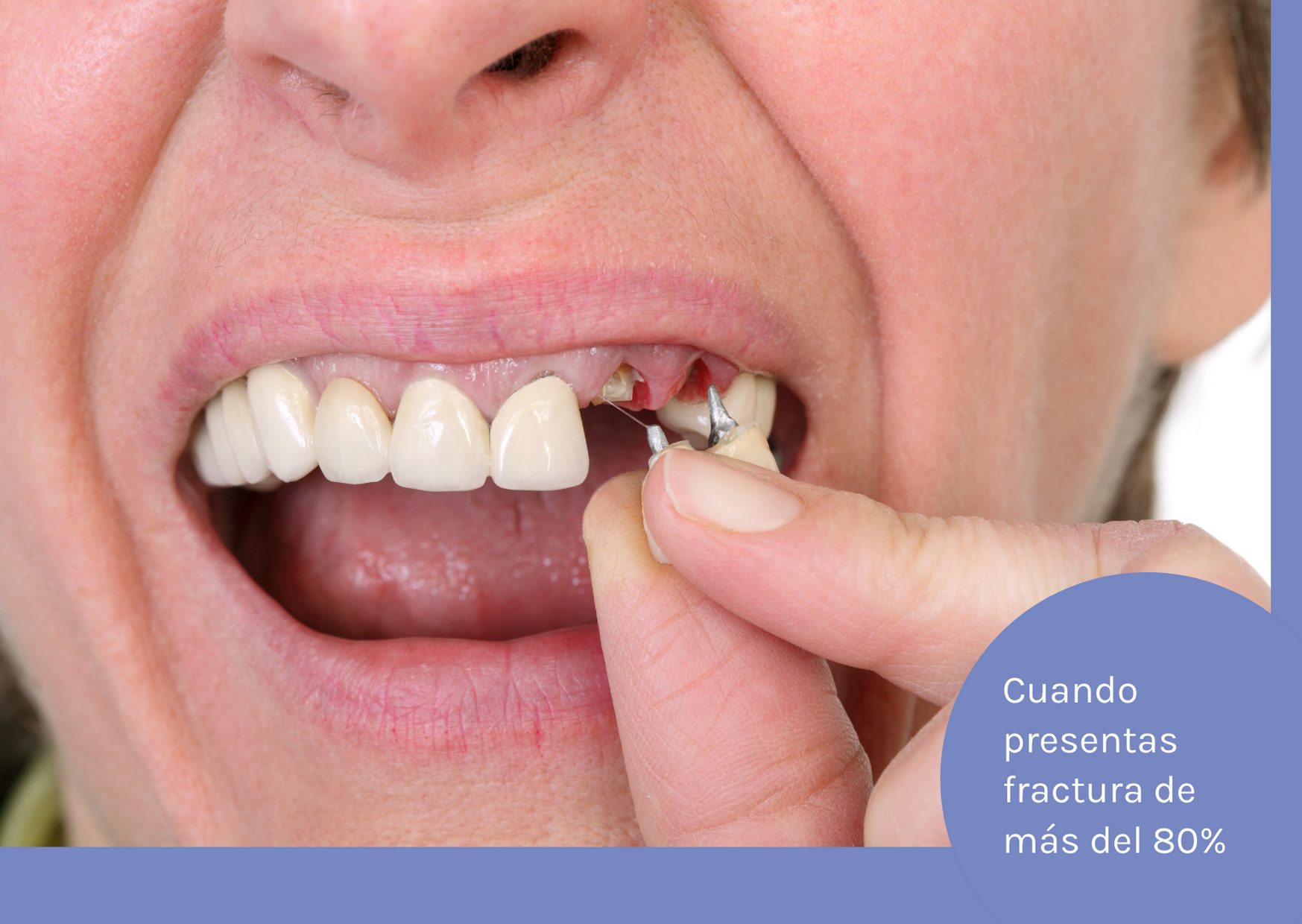 corona dental cuando hay fractura