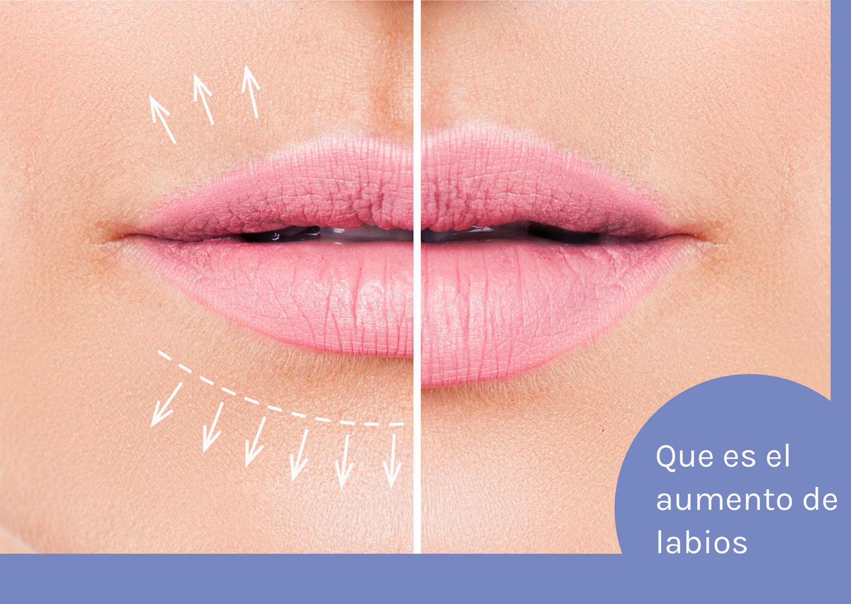 que es aumento de labios