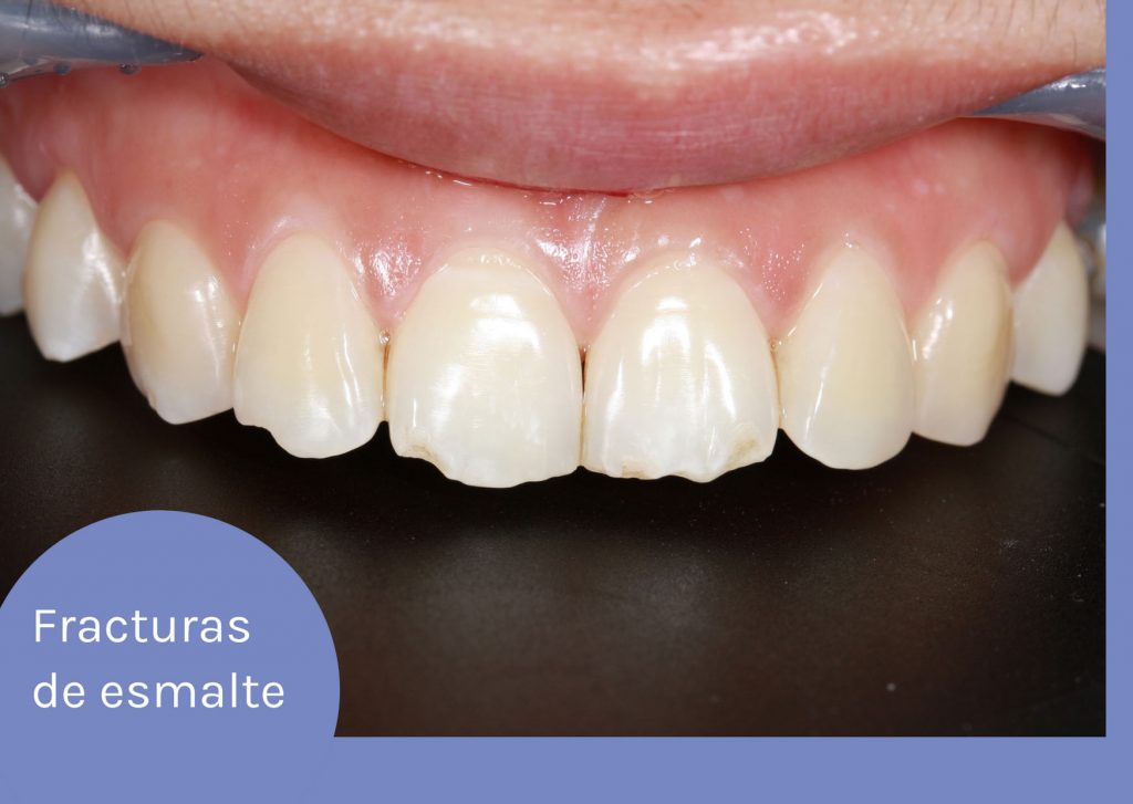 fractura dental de esmalte