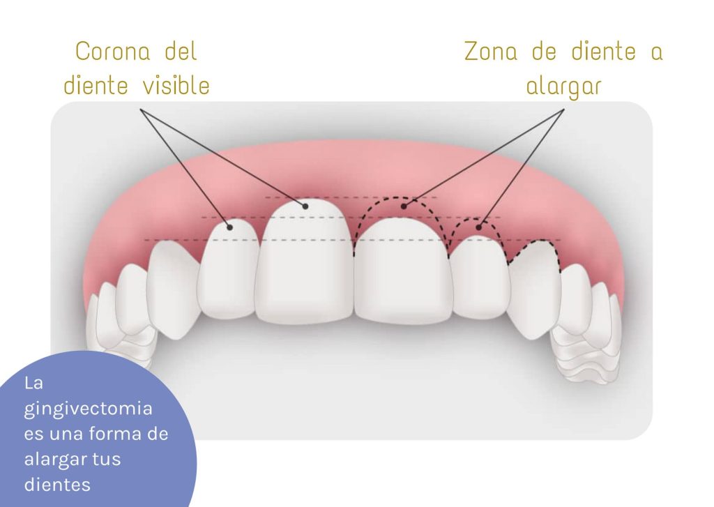 lo que nunca te contaron gingivectomia