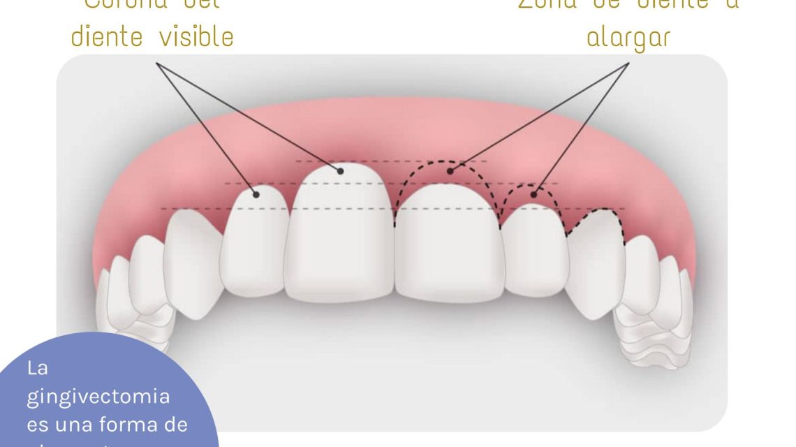 lo que nunca te contaron gingivectomia