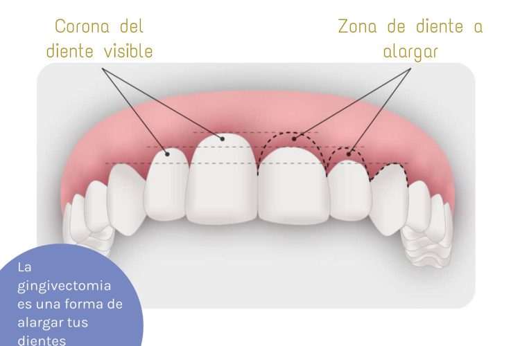 lo que nunca te contaron gingivectomia