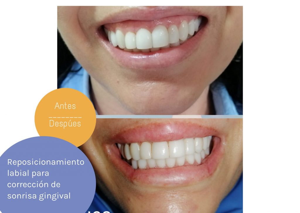 reposicionamiento gingivectomia