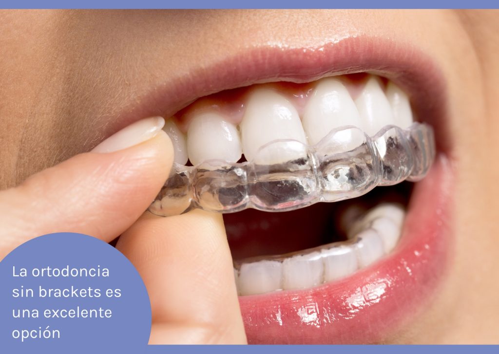 diseño de sonrisa con brackets