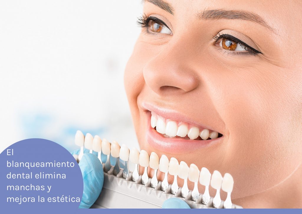 diseño de sonrisa con blanqueamiento