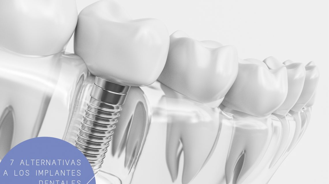 alternativas a implantes dentales