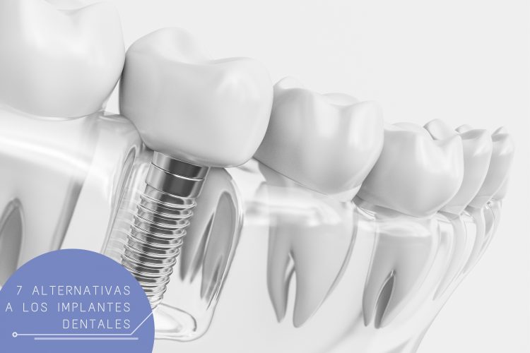 alternativas a implantes dentales