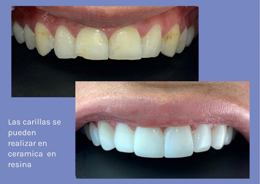 How much does it cost a smile design in Colombia in 2023