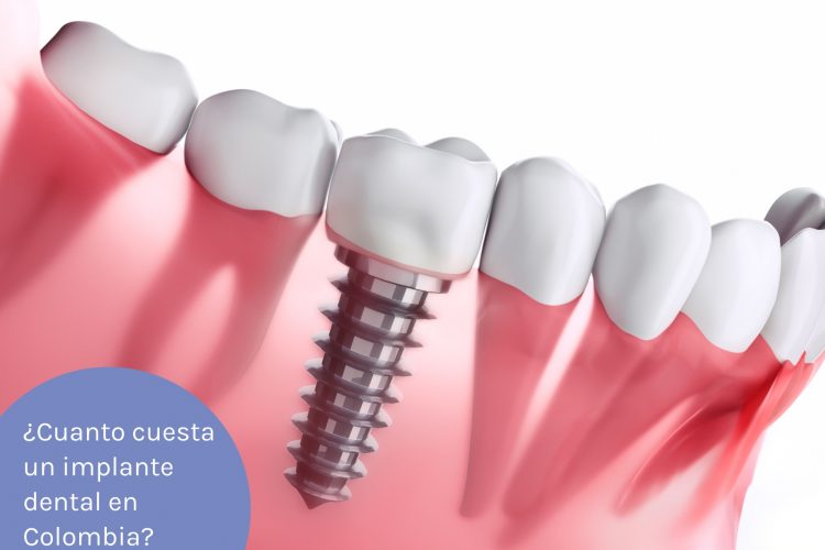 cuanto cuesta un implante dental