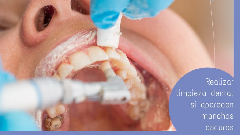 limpieza dental