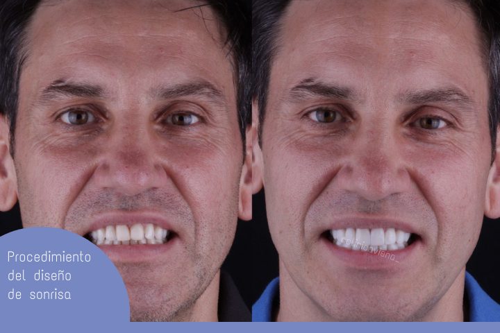 Procedimiento de diseño de sonrisa es una de las primeras cosas que las personas notan cuando conocen a alguien. - This post will delve into various types of Smile Design Procedure, Everything You Need to Know, along with their pros and cons.