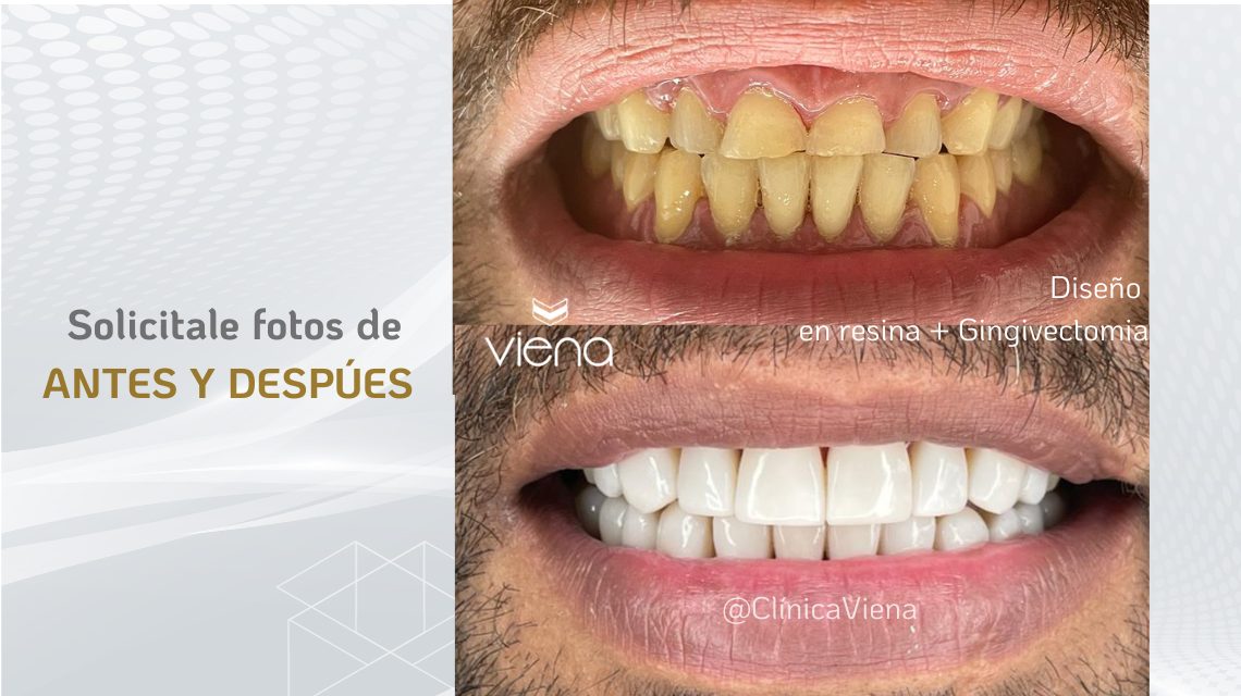 how to choose the best dentist: Antes y despues, before and after