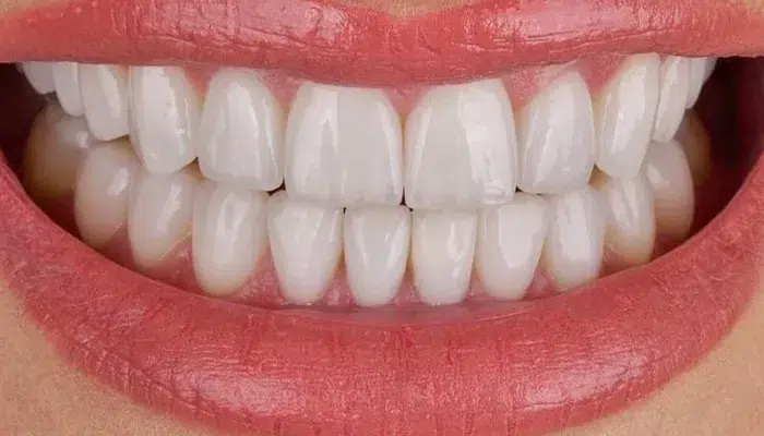 Close-up of a person's smile showing perfectly aligned and white teeth with dental veneers.