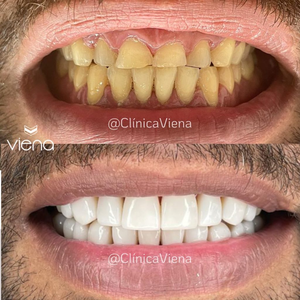 dental transformation with veneers in Colombia by Clínica Viena