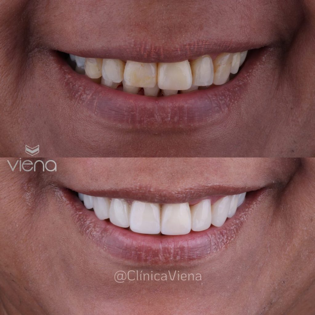 Before and after smile makeover with veneers in Colombia at Clínica Viena.