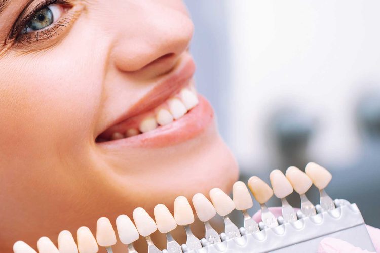 Smiling woman in a dental chair with a shade guide for dental veneers