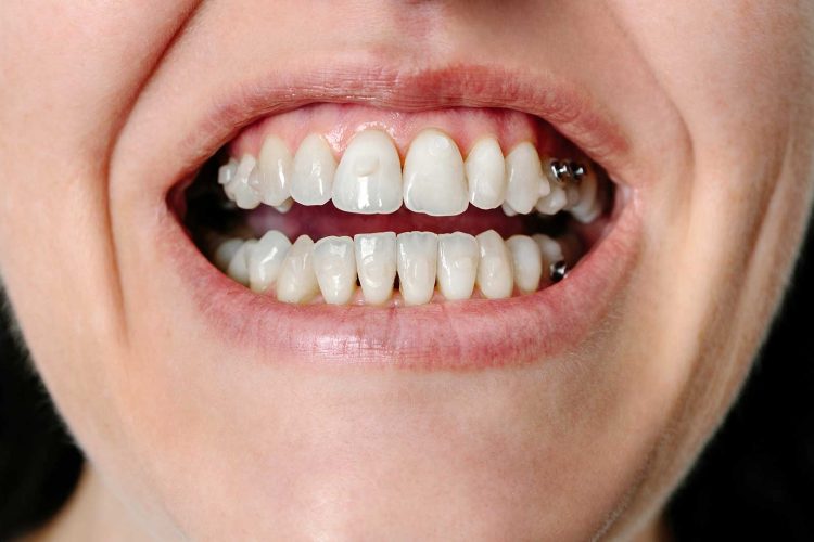 Close-up of teeth with dental veneers showing signs of decay and damage.