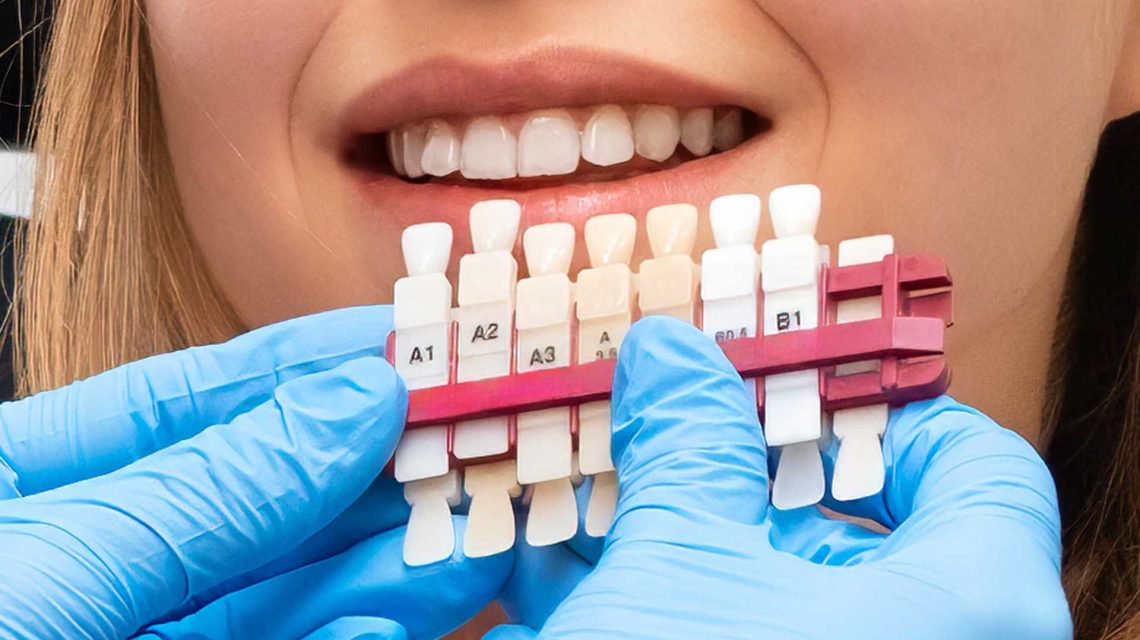 Dental professional with blue gloves holding a shade guide in front of a patient's mouth to select the color for Affordable Veneers in Colombia