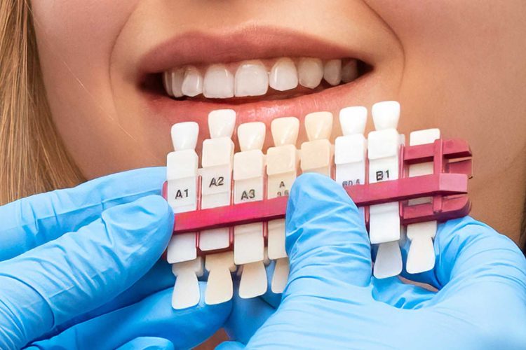 Dental professional with blue gloves holding a shade guide in front of a patient's mouth to select the color for Affordable Veneers in Colombia