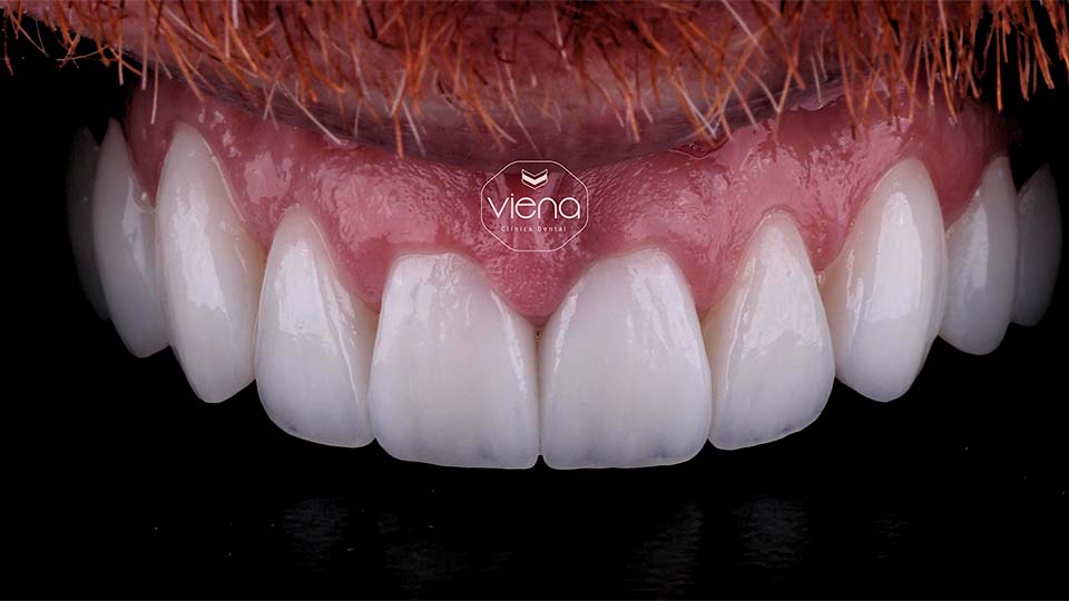 veneers before and after Affordable Dental Veneers