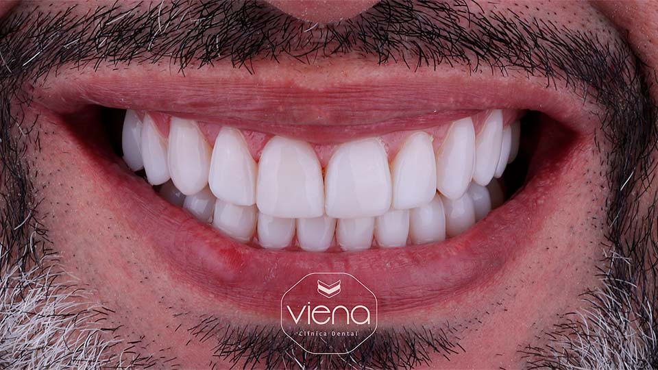veneers before and after Best Dentist Medellín