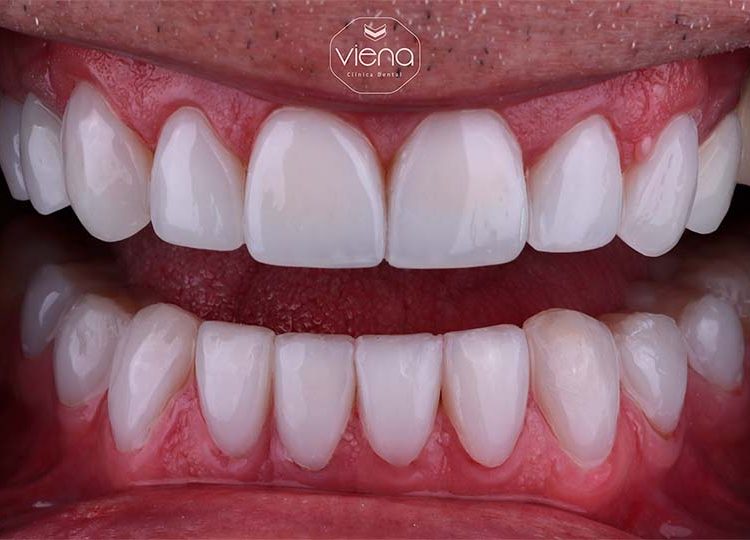 veneers before and after Clínica Viena_