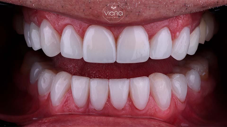 veneers before and after Clínica Viena_