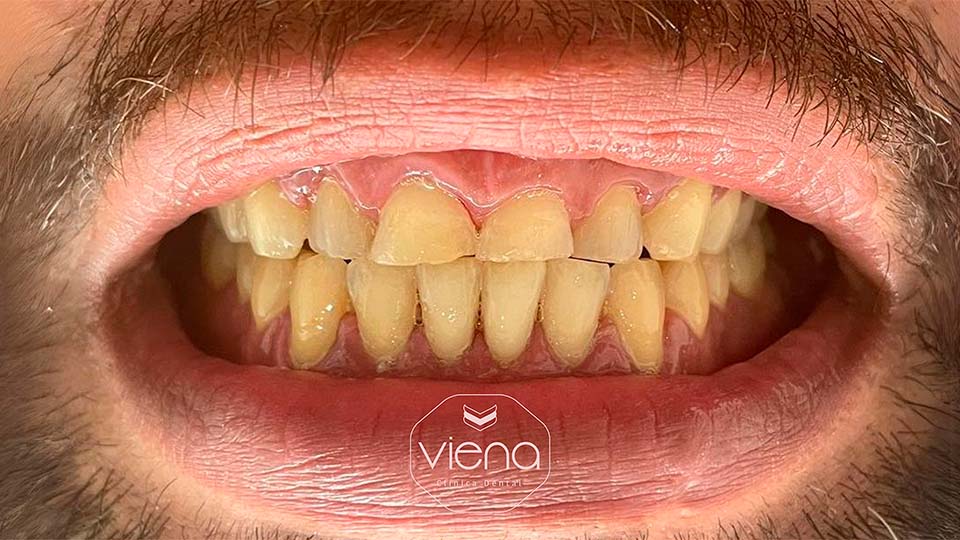 veneers before and after Cosmetic Dentistry Medellín_