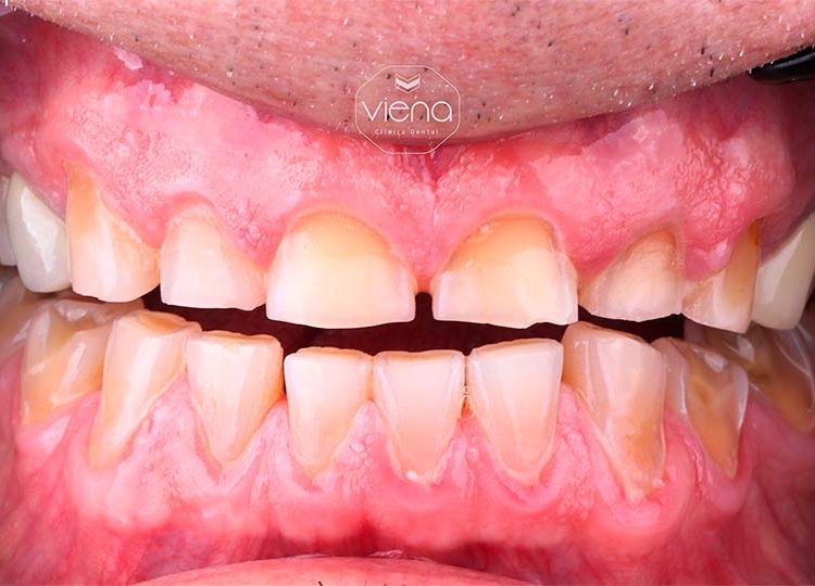 veneers before and after Dental Tourism Medellín_