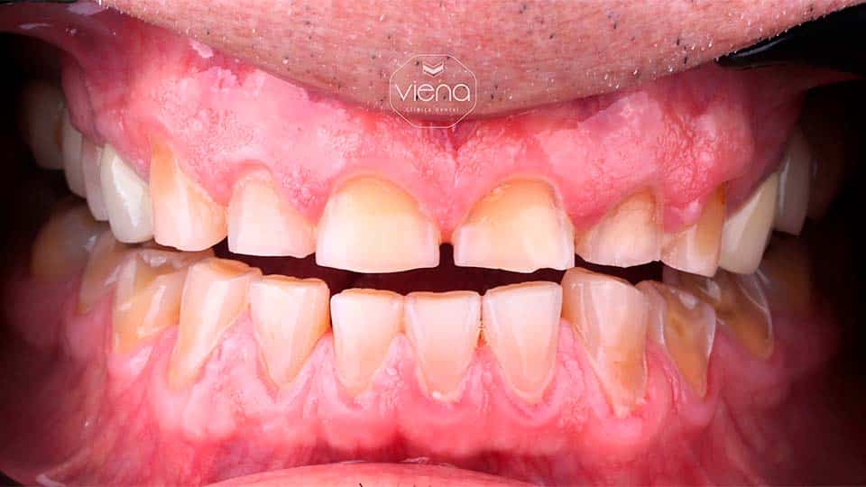veneers before and after Dental Tourism Medellín_