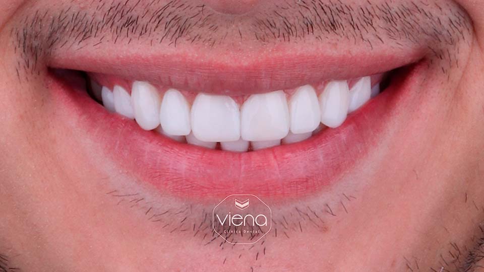 veneers before and after Dental Travel Colombia