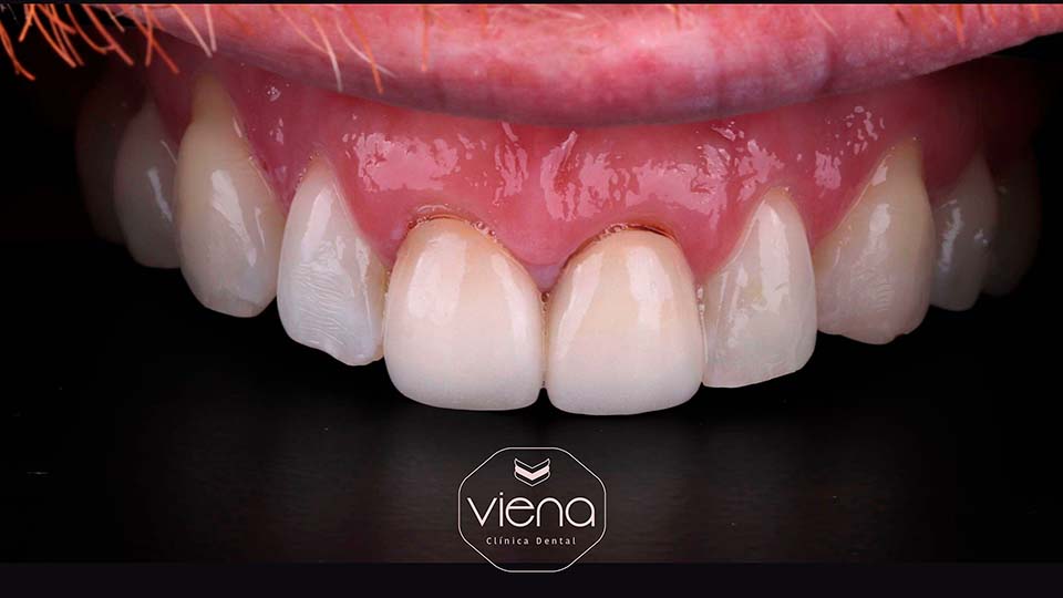 veneers before and after Dental Veneers Colombia_veneers before and after Dental Veneers Colombia_