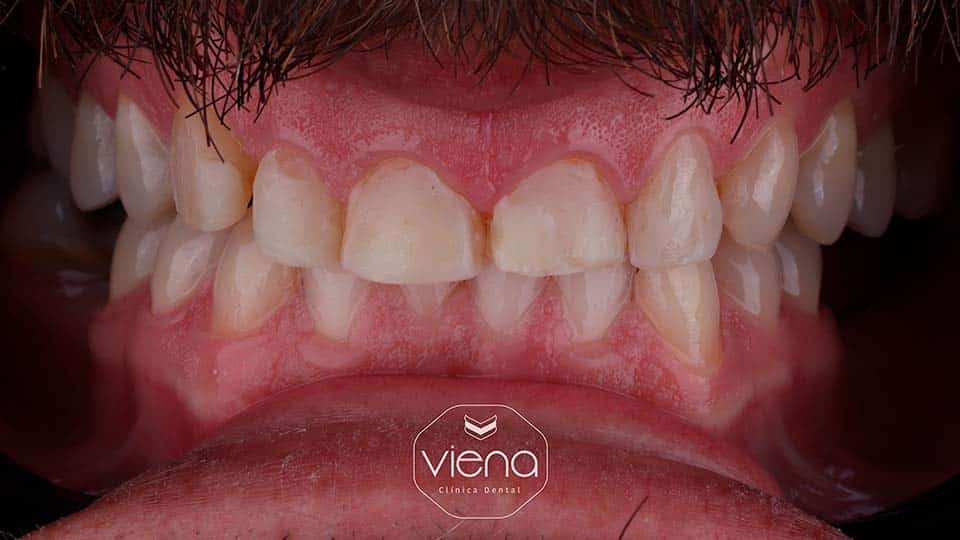 veneers before and after Medellín Veneers