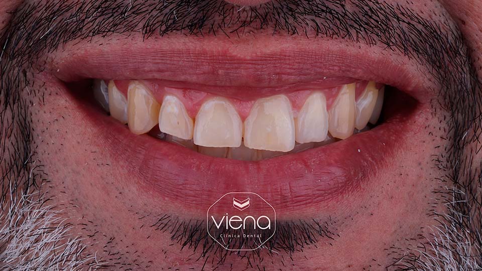 veneers before and after Porcelain Veneers Colombia_