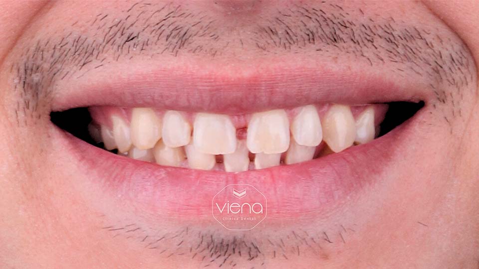 veneers before and after Smile Makeover Colombia