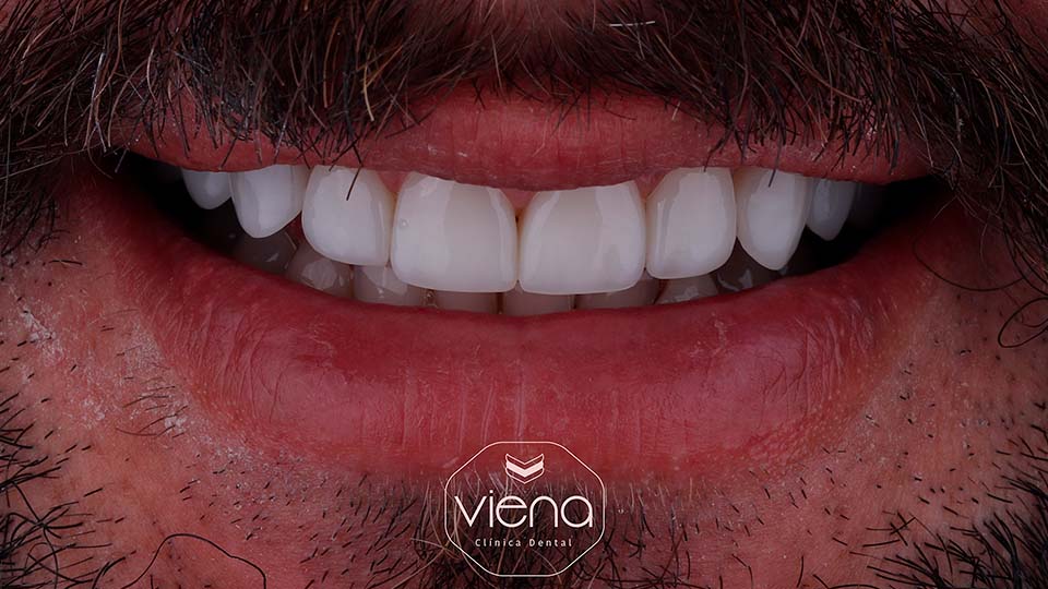 veneers before and after Veneers Before and After