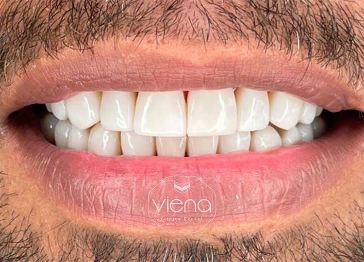 veneers before and after Veneers for US Patients_