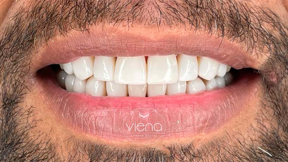 veneers before and after Veneers for US Patients_