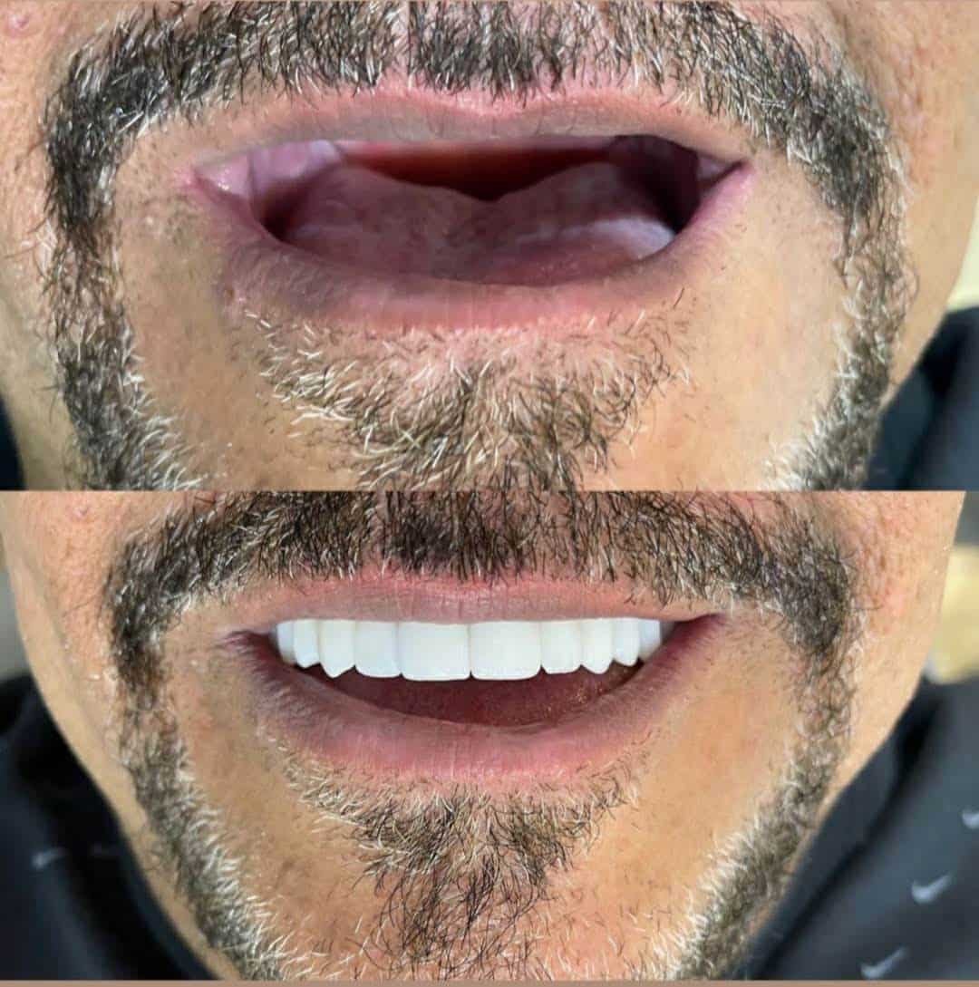 Implantes dentales Medellin