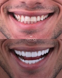 Blanqueamiento dental: Precio en Colombia 2025