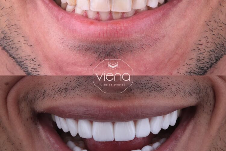 Blanqueamiento dental: Precio en Colombia 2025 Blanqueamiento dental: Precio en Colombia 2025