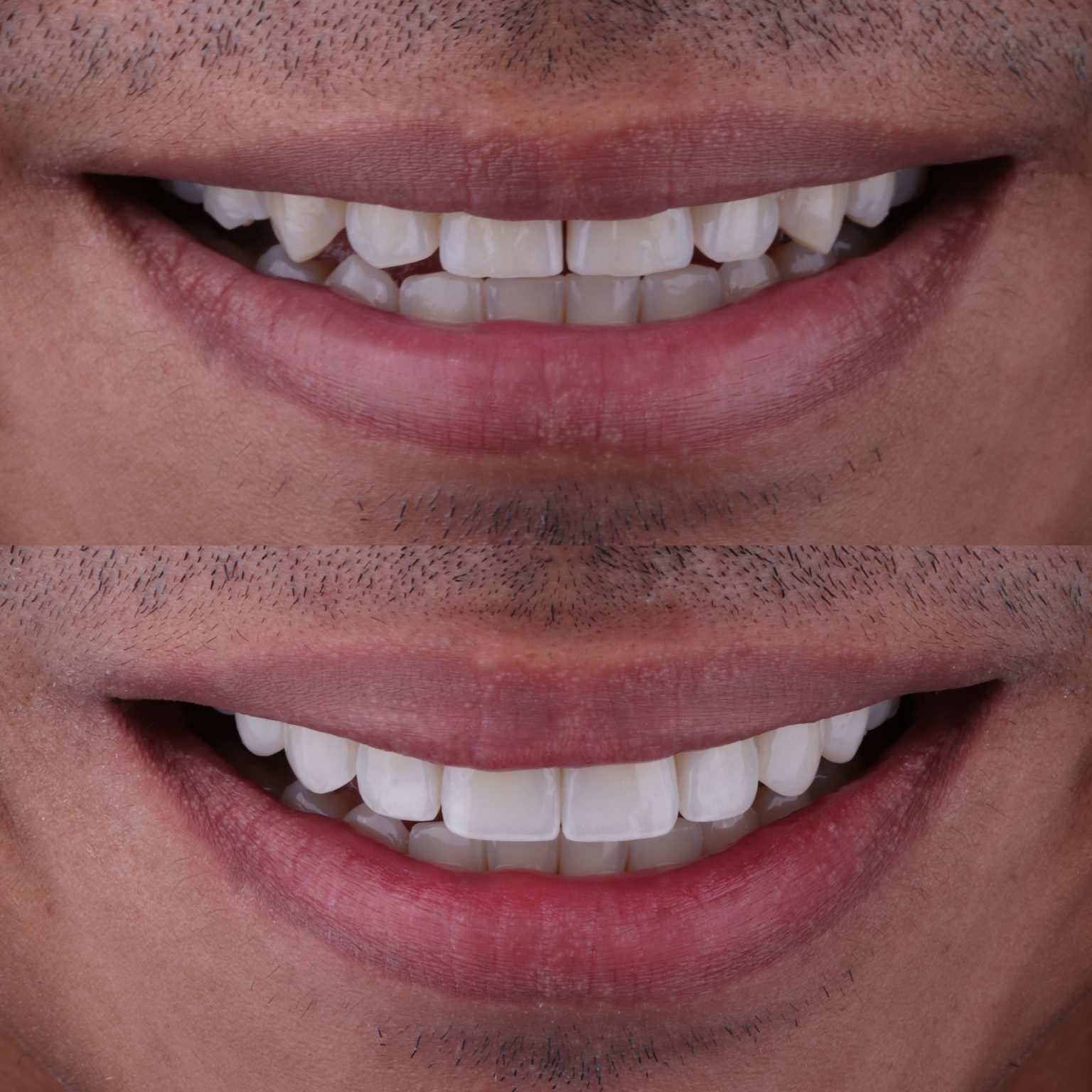Microdiseño de sonrisa