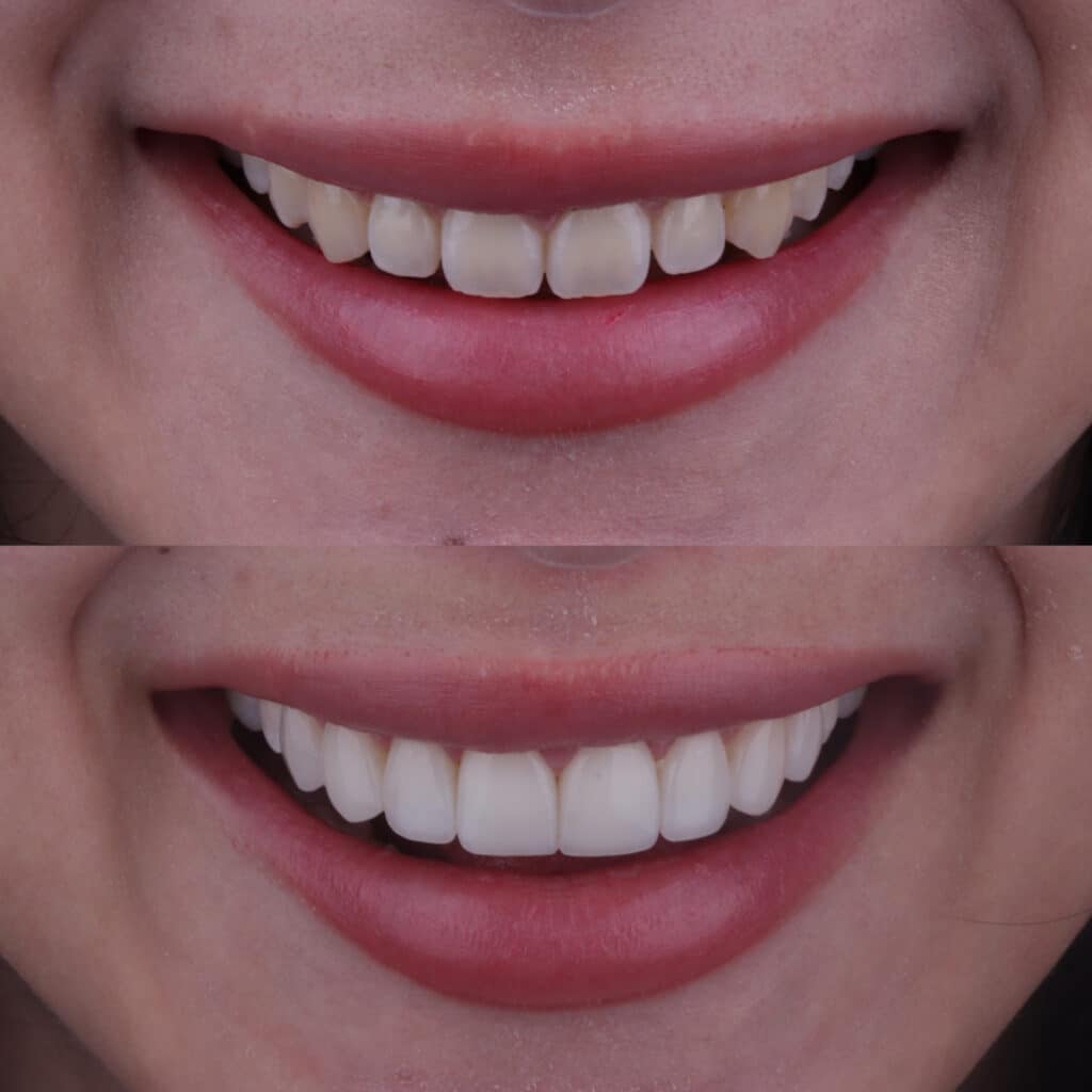 Microdiseño de sonrisa