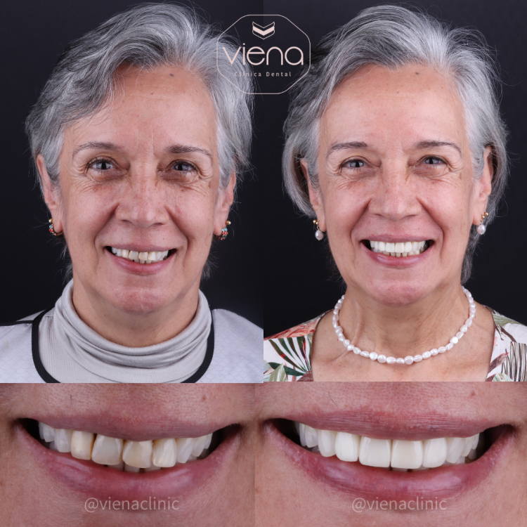 Crowns and Veneers Before and After