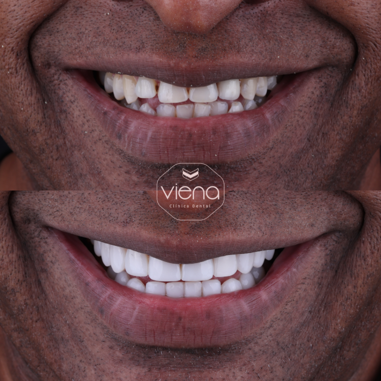 Diseño de sonrisa antes y despues
