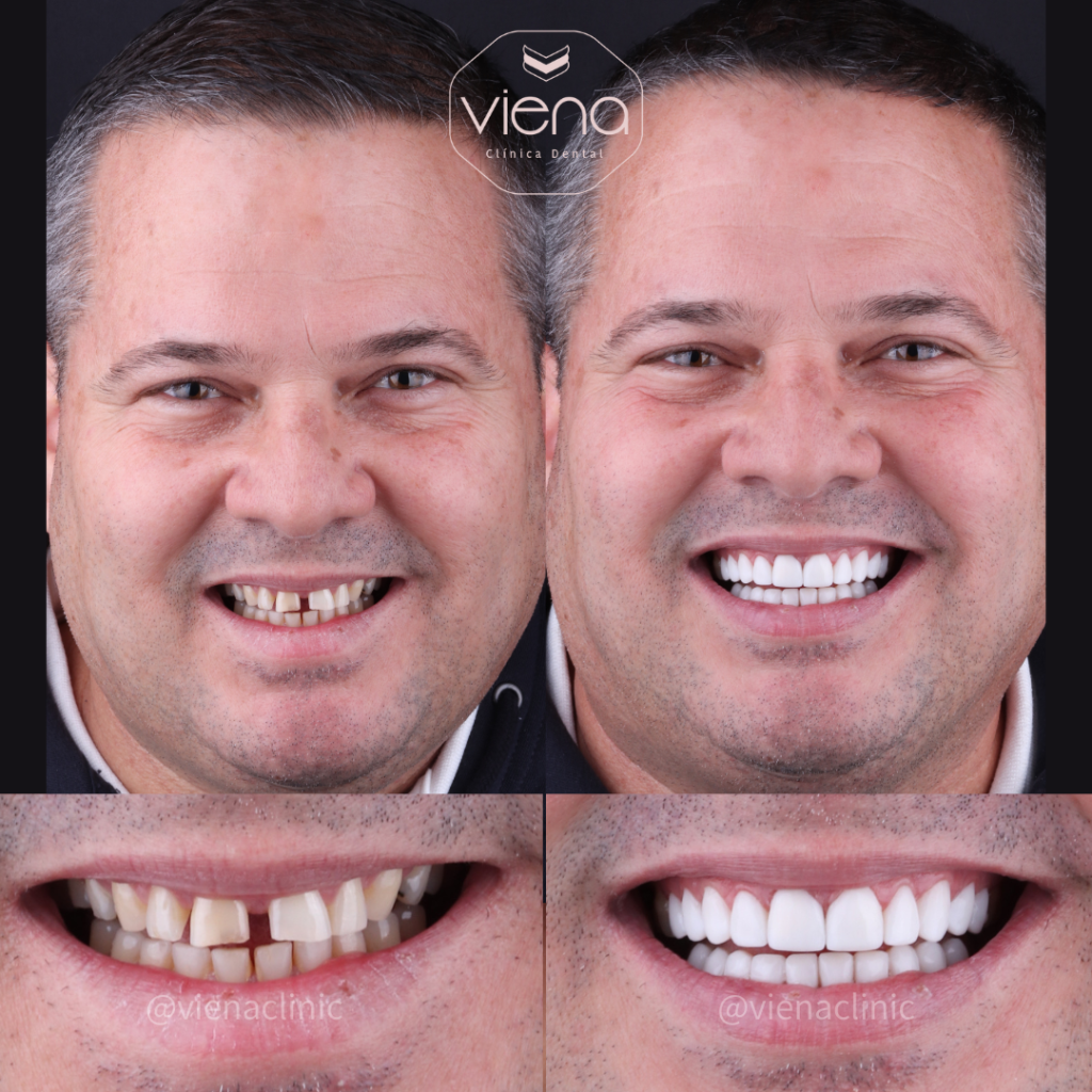 Gap Teeth Veneers Before and After