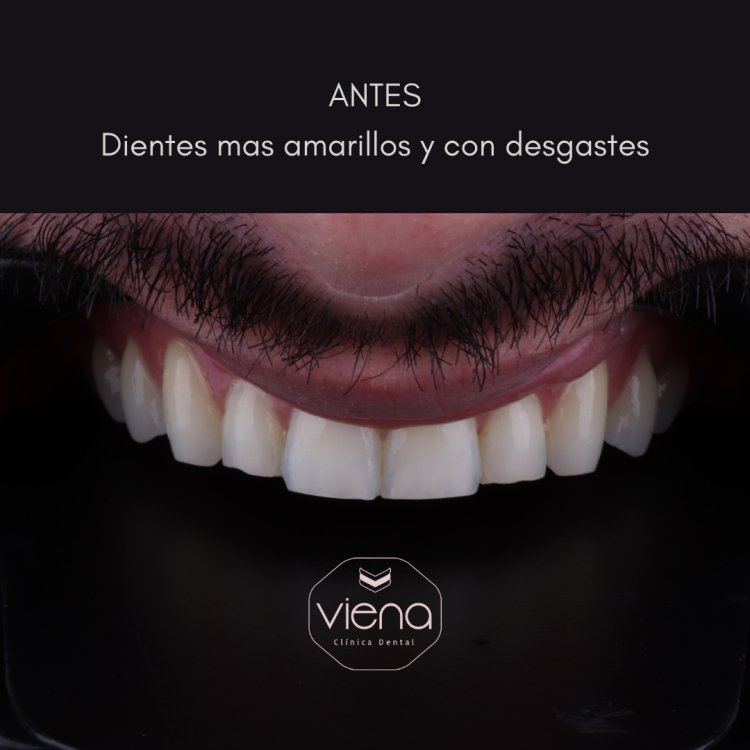 Diseño de sonrisa antes y despues