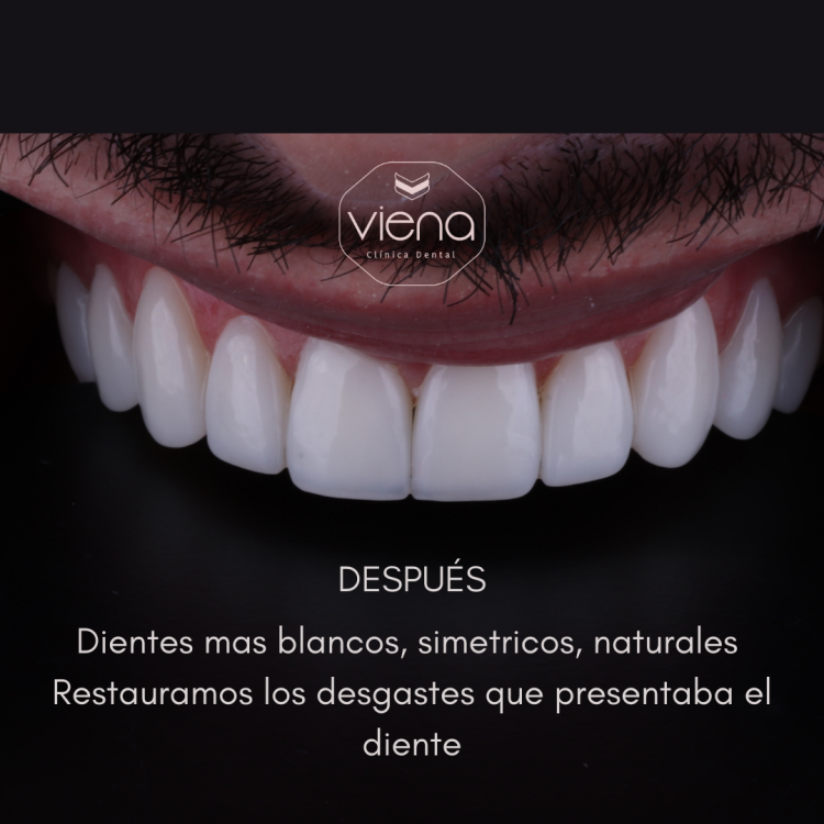 Diseño de sonrisa antes y despues