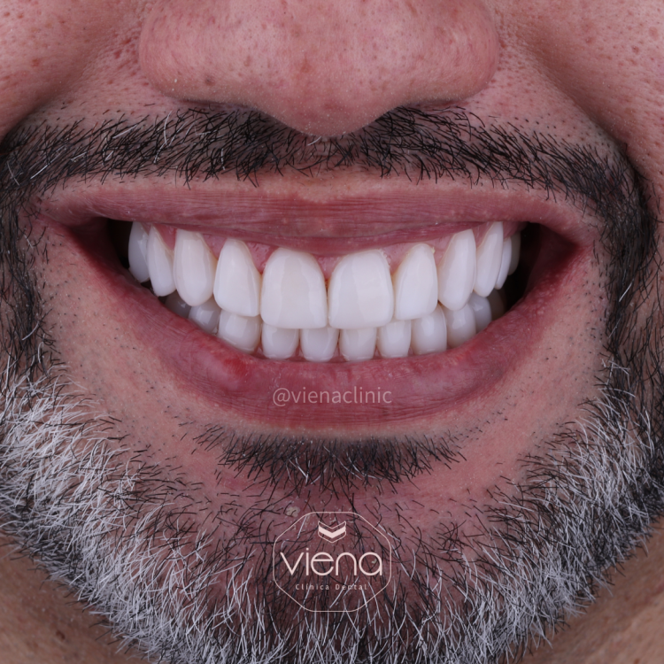 Diseño de Sonrisa Antes y Después